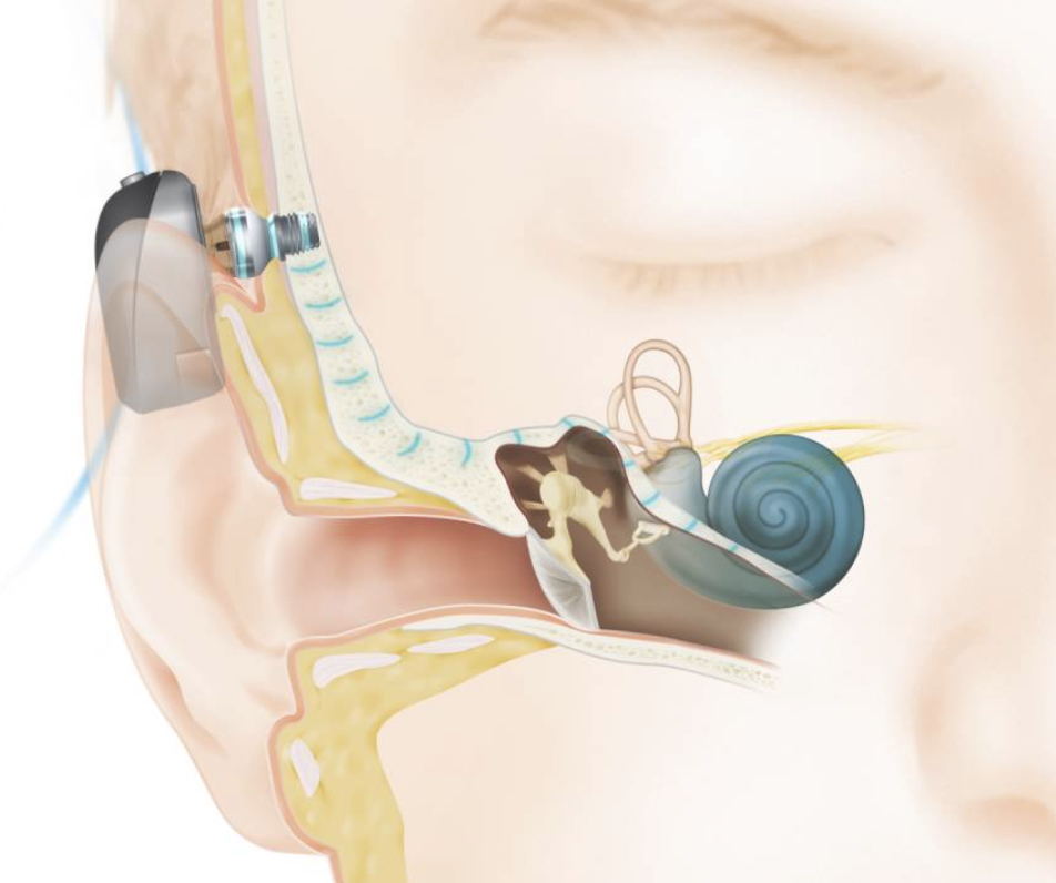 Bone anchored hearing aid