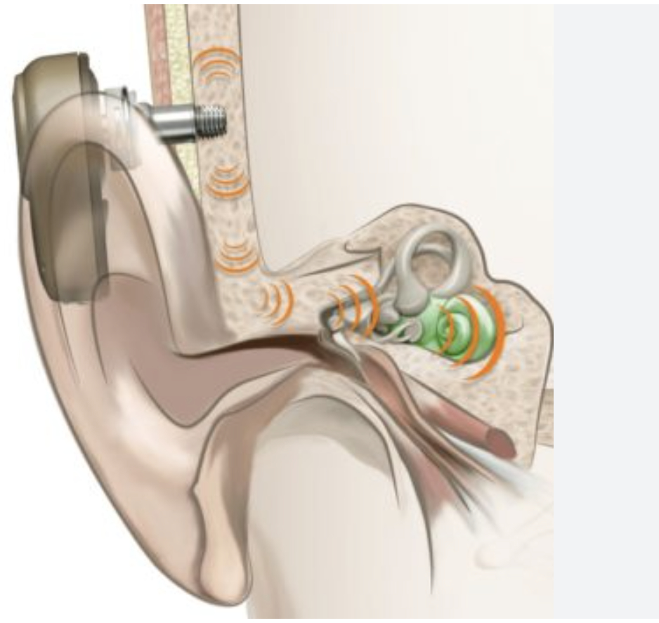 Bone conduction hearing aid