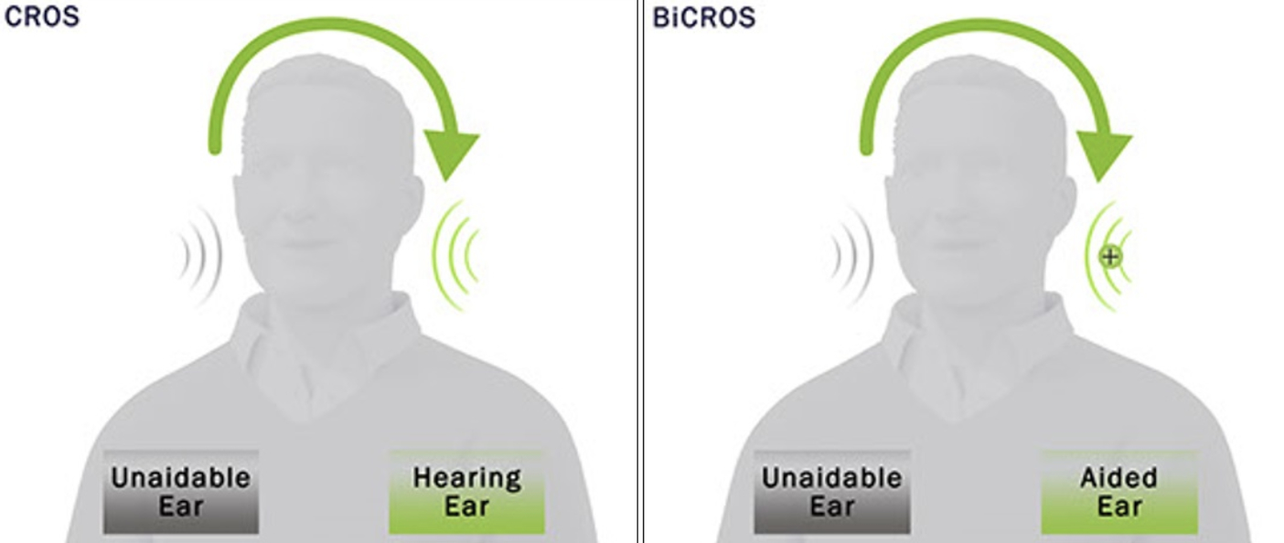 Cros and bicros hearing aid systems avaiable on the NHS